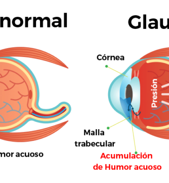 glaucoma
