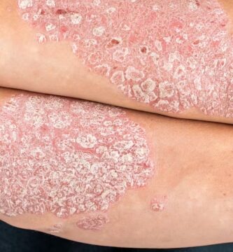 psoriasis